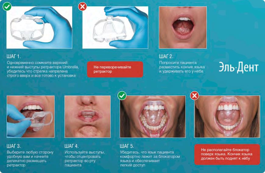      Umbrella Ultradent