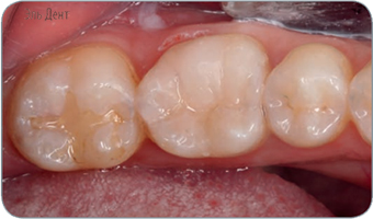   GC G-aenial Posterior