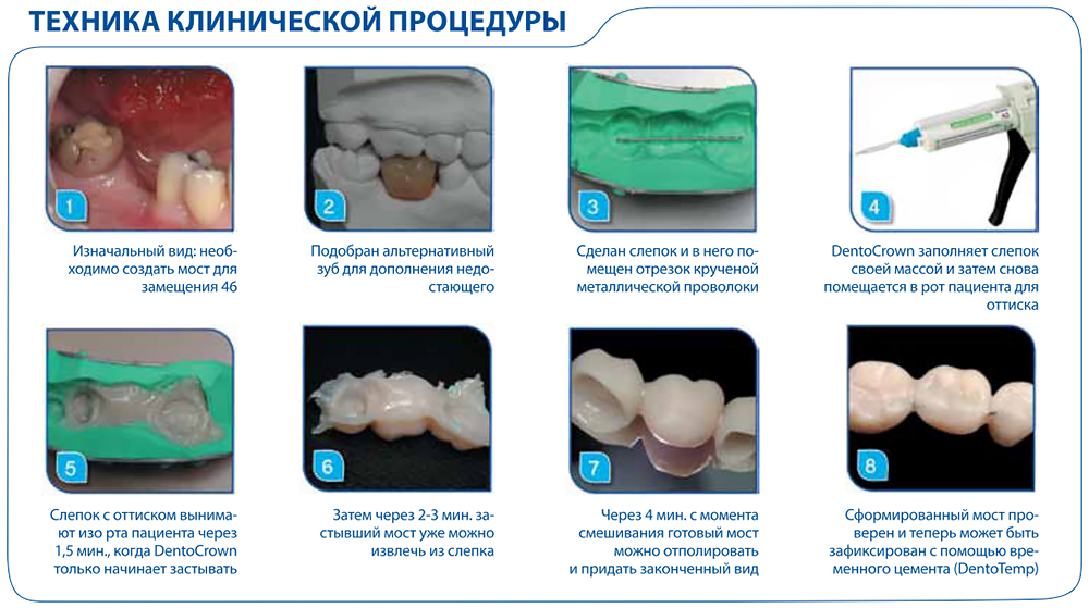 Временные коронки презентация