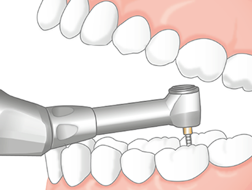  NSK ENDO-MATE TC2