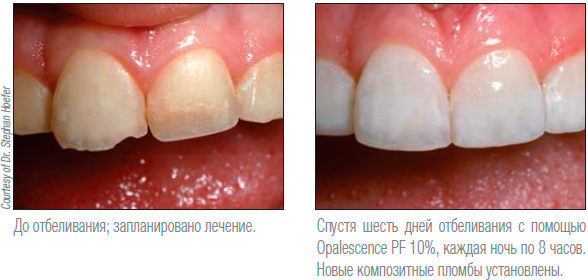Отбеливание зубов Opalescence Томск Ягодная