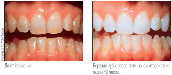 Отбеливание зубов Opalescence Томск Ягодная аптека 10 томск герцена