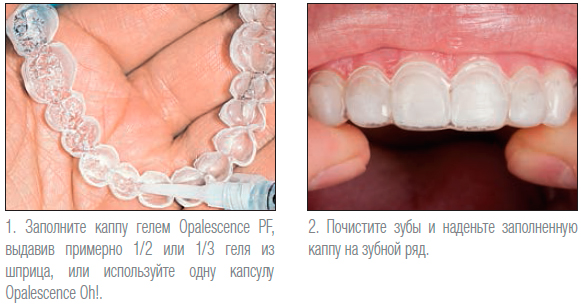 отбеливание зубов opalescence или zoom