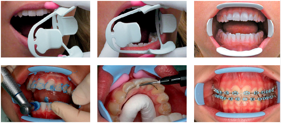 Оптрагейт в стоматологии фото