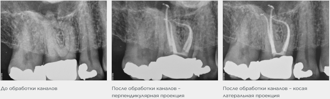 ПроТейперы,ProTaper Майлифер GOLD  (СТЕРИЛЬНЫЕ)  (6шт) машинные S1(25мм)