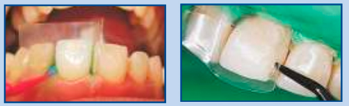 установка пластин пластиковых лавсановых сепарационные в стоматологии