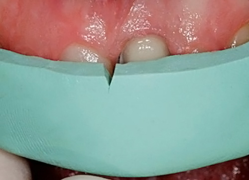 Установка силиконового ключа в полости рта